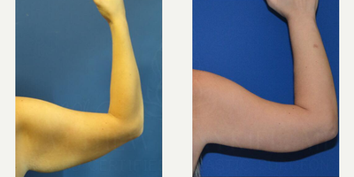 Woman treated with Arm Lift - Woman treated with Arm Lift