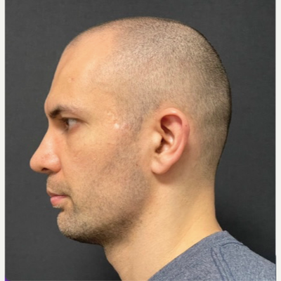 25-34 year old man treated with Genioplasty - Genioplasty