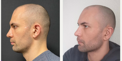 25-34 year old man treated with Genioplasty - Genioplasty