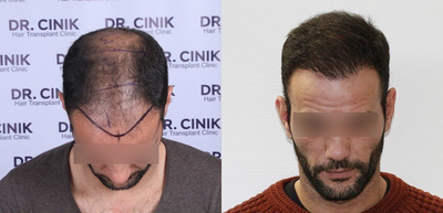 Man treated with FUE Hair Transplant - Man treated with FUE Hair Transplant using 4500 grafts, shown 7 months post op.