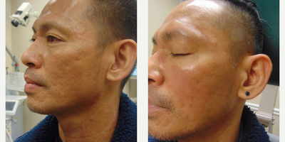 Man treated with Subcision - This patient had one treatment of subscision with PRP to treat acne scars.