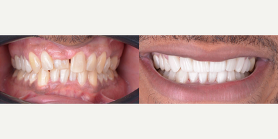 Man treated with Porcelain Veneers, Gum Lift - Man treated with Porcelain Veneers, Gum Lift