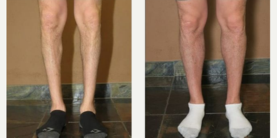 Man treated with Calf Implant - Man treated with Calf Implant