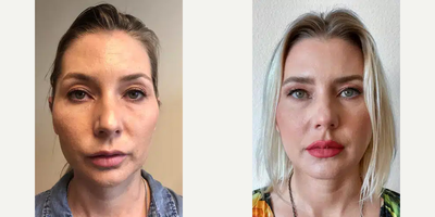 35-44 year old woman treated with Jaw Surgery - Female patient presenting with a common case of orthodontic camouflage treatment and its subsequent failure. A maxillomandibular advancement (MMA) procedure, otherwise known as double jaw surgery, was performed. The patient underwent a LeFort 1 osteotomy on her maxilla and a segmental bilateral sagittal split osteotomy (BSSO) on her mandible along with a counter-clockwise (CCW) rotation to bring the occlusal plane into it's optimal position and optimize both form and function. The lower jaw (mandible) was ultimately brought forward by 12.94mm at the pogonion (the forward-most point on the chin), and the upper jaw (maxilla) was brought forward by 5mm. A counter-clockwise rotation of approximately 8 degrees was also performed to lengthen the lower third of the face to balance the bimaxillary movements, further improve the airway, stabilize the occlusion (the bite), and achieve complete facial harmony. 3D-printed custom orthognathic hardware by Stryker was used for the procedure.