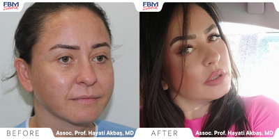 35-44 year old woman treated with Mini Facelift, Double Eyelid Surgery, Facial Fat Transfer - A 40 years old woman was treated with Mini face lift, upper and lower eyelids and facial fat transfer. After 7 months of the operation, she sent this phot.