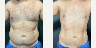 Woman treated with Vaser Liposuction - Woman treated with Vaser Liposuction- 6 months post-op