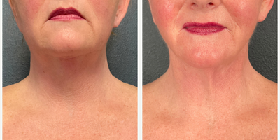 Woman treated with Vaser Liposuction - Woman treated with Vaser Liposuction- 6 months post-op