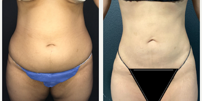 Woman treated with Vaser Liposuction - Woman treated with Vaser Liposuction- 6 months post-op