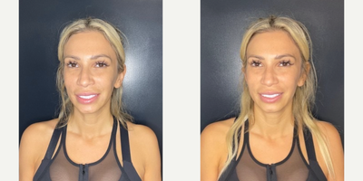 35-44 year old woman treated with Dermal Fillers - 1 syringe of RHA Redensity to soften the nasolabial folds.