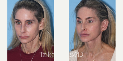 55-64 year old woman treated with Facelift - Deep Plane Facelift, Platysmaplasty, Lip lift, Lipografting & Upper Blepharoplasty