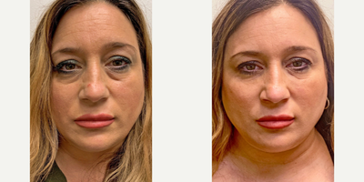 Cheek and Tear-Trough Filler - 1 cc of Restylane to each tear-trough and 1 syringe of RHA2 in the cheek/malar area.  Like many women, 1 cheek had less volume than the other (typically due to sleeping positions and other daily activities) so the 1 syringe of RHA 2 was divided accordingly to add more volume to her deflated right side versus the left to improve facial symmetry.