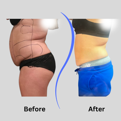 45-54 year old woman treated with Body-Jet Liposuction - Abs and Flank Liposuction with Funsculpting