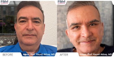 55-64 year old man treated with Facelift, Deep Plane Facelift, Neck Lift, Facial Fat Transfer, Eyelid Surgery - 55-64 year old man treated with Facelift, Deep Plane Facelift, Neck Lift, Facial Fat Transfer, Eyelid Surgery