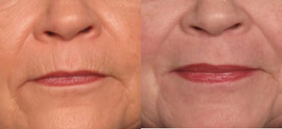 Woman treated with Microdermabrasion using Dermasweep - Woman treated with Microdermabrasion using Dermasweep