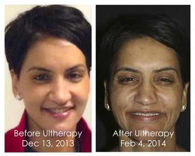 Devastating Ultherapy Results Review Realself