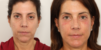 45-54 year old woman treated with Ptosis Surgery - Ptosis Repair