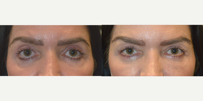 48 year old underwent Corrective Lower Eyelid Retraction Repair - 48 year old female underwent lower eyelid retraction repair to correct botched lower blepharoplasty that had resulted in lower eyelids being pulled down.
