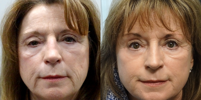 65-74 year old woman treated with Ptosis Surgery - Treated with Ptosis Repair Right Upper Lid and Full Face CO2 Laser.