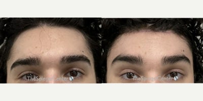 18-24 year old woman treated with Forehead Reduction - 18-24 year old woman treated with Forehead Reduction