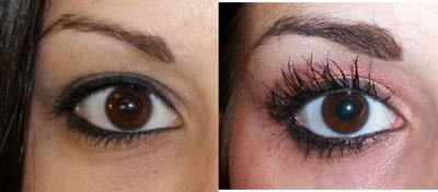 Latisse - Pre and Post Latisse