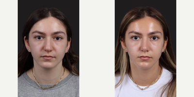 Woman treated with Rhinoplasty, Septoplasty - Woman treated with Rhinoplasty, Septoplasty