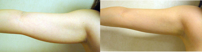 Laser Liposuction to Arms - Laser Liposuction - SlimLipo technique. Fat reduction and skin tightening. Arm Lift with Laser Liposuction only.