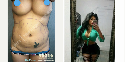 Woman treated with Liposculpture - Woman treated with Liposculpture