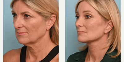 55-64 year old woman treated with Facelift - This patient in her mid-50s shares how her facial rejuvenation helped reverse the aging that comes along with cancer. Dr. Balikian performed a Deep Plane Facelift with Deep Necklift, Upper Blepharoplasty, Lower Eyelid Skin Pinch, Rhinoplasty, Facial Fat Transfer and 4 Point Brow Lift.
