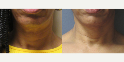 60 year old woman treated with Profound RF - 60 year old woman treated with Profound RF to chin