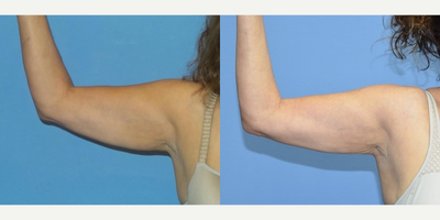 55-64 year old woman treated with BodyTite - This is a 57 y/o female who was unhappy with the appearance of her arms. She did not like wearing short sleeve outfits due to excess skin and fat to her upper arms. She underwent BodyTite liposuction of her arms in the office under local anesthesia. She is shown 3 months after the surgery with better sculpted arms.