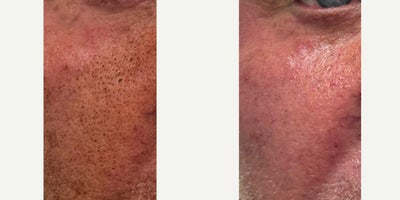 45-54 year old man treated with Sylfirm X - Sylfirm X treatment for skin texture