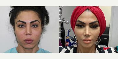 25-34 year old woman treated with Chin Implant - 25-34 year old woman treated with Chin Implantas well as Buccal Fat Removal,Brow Lift, Lip Lift, and Facial Fat Transfer, shown 4 months post op.