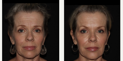 Woman treated with Emface - Emface