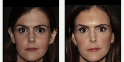 Woman treated with Emface - Emface