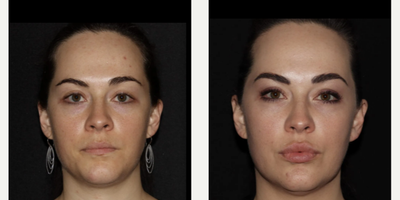 Woman treated with Emface - Emface