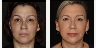 Woman treated with Emface - Emface