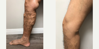 35-44 year old man treated with EVLT - Make 3 months post EVLT Life changing results