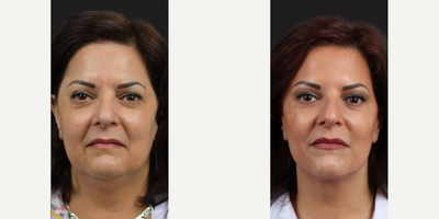 Woman treated with Kybella - Woman treated with Kybella