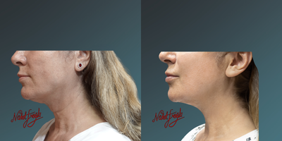 35-44 year old woman treated with Thermage FLX - 35-44 year old woman treated with Thermage FLX