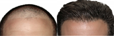 Man treated with ARTAS Robotic Hair Transplant - Photo provided courtesy of Restoration Robotics, Inc., performed by Gregory A. Turowski, MD