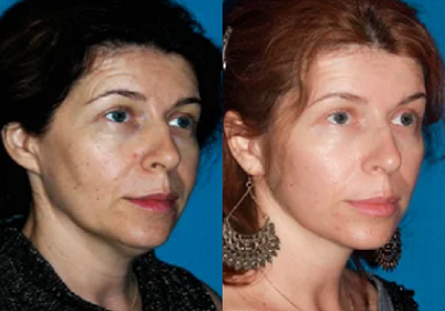 Mini Lift - Patient of Dr. Konstantin underwent a Mini Lift.