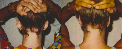 Otoplasty - 	Patient is shown before and after bilateral otoplasty.