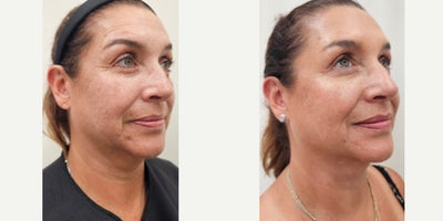 55-64 year old woman treated with Dysport, Sculptra, Radiesse, Alastin Skincare - Tailored treatment plan with combined procedures on same session: Dysport on upper third of the face2 vials of Sculptra for the whole face2 vials of reconstituted Radiesse for the neckAlastin Skincare started after her first consultation