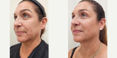 55-64 year old woman treated with Dysport, Sculptra, Radiesse, Alastin Skincare - Tailored treatment plan with combined procedures on same session: Dysport on upper third of the face2 vials of Sculptra for the whole face2 vials of reconstituted Radiesse for the neckAlastin Skincare started after her first consultation
