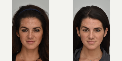 25-34 year old woman treated with Thread Lift - Thread lift is used to reduce smile lines and smooth the jawline for a more consistent face shape.