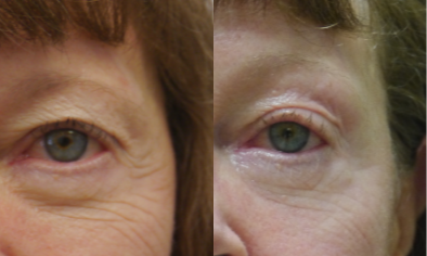 65-74 year old woman treated with TempSure Envi - 69 year-old Female with deep wrinkles that have softened and improved after 3 TempSure Envi treatments around the eyes spaced 1 month apart. Notice how the brow has lifted and the upper eyelid skin has tightened without surgery!