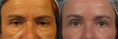 Botox and Juvederm Ultra around the eyes - 
	Botox was used around the crow's feet and glabella while Juvederm Ultra was used to treat the deep glabellar crease,lower eyelids and cheeks.
