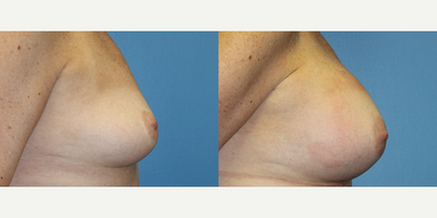 45-54 year old woman treated with Breast Augmentation - Height : 5'7 
WT : 152 
Age : 50 
Implant make : Allergan Natrelle 
style :371 cc right 397 cc left silicone gel mid profile Allergan 
placement : sf (subfascial)