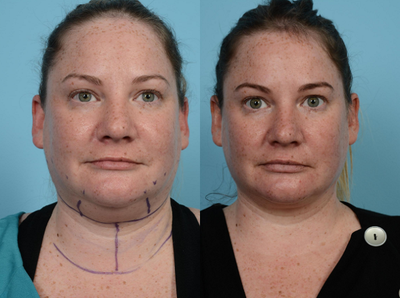 Patient treated with Laser Treatment - Patient treated with Laser Treatment