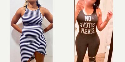 25-34 year old woman treated with Liposuction, Brazilian Butt Lift - Excellent outcome after full body intense liposuction including abdomen, waist, laterals, upper and lower back plus DOMINICAN BUTT LIFT by Mallol getting better volume, contour and butt projection.